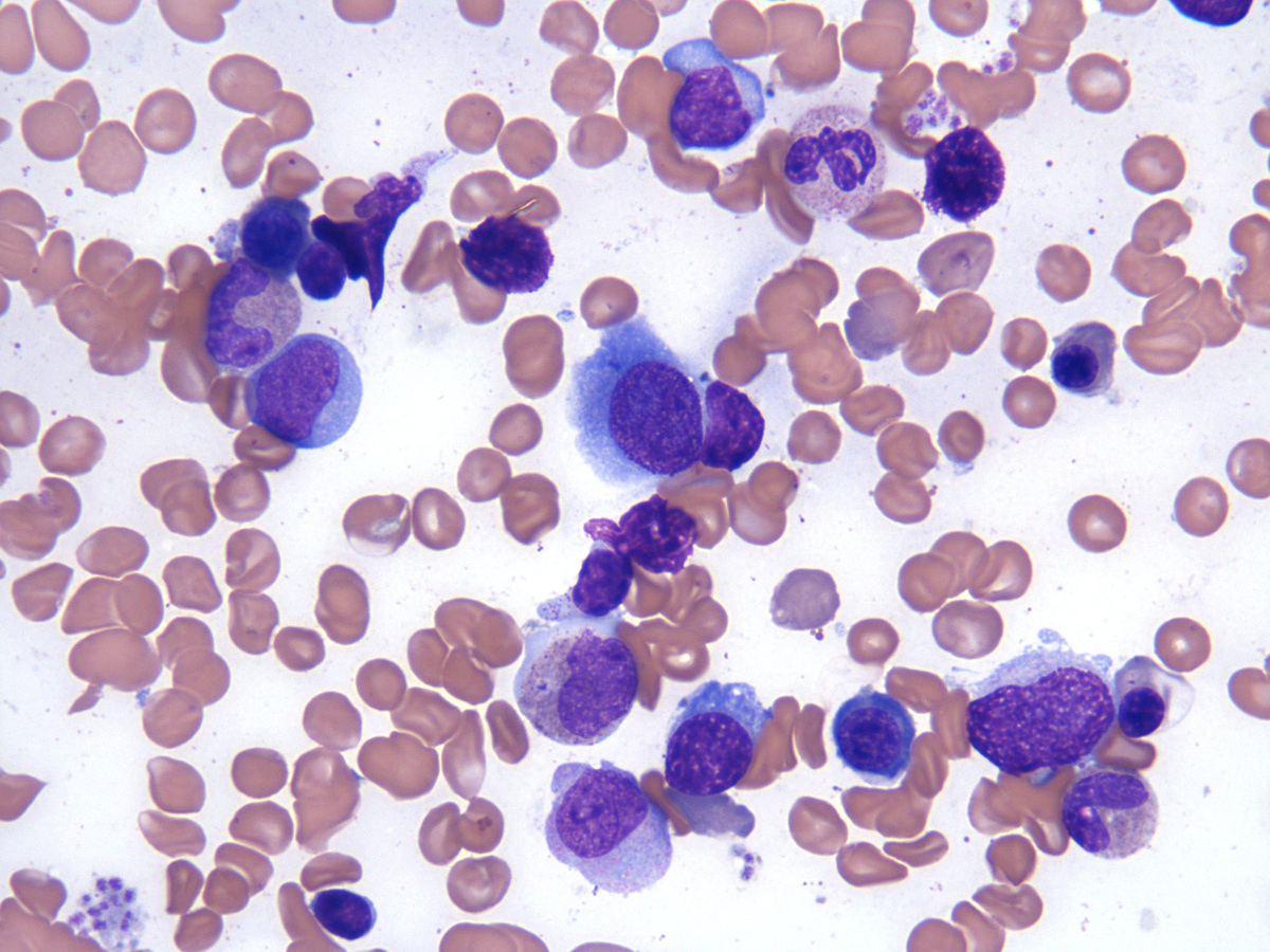 Bone marrow aspirate_3